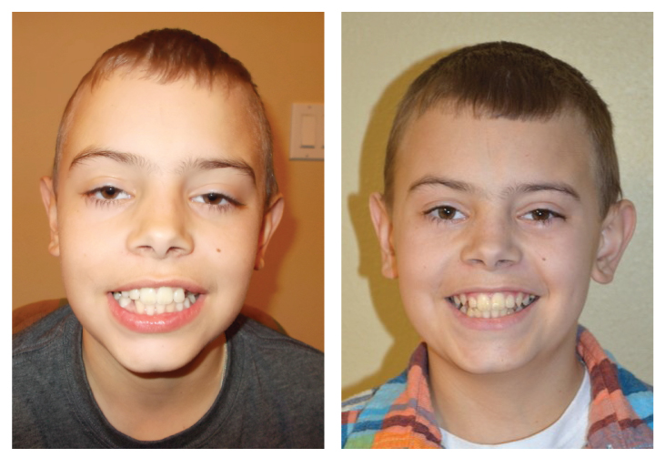 Gunner - Before & After